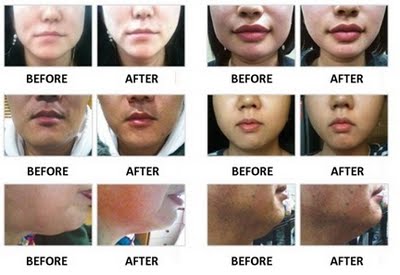 face slimming mask before and after 7 months