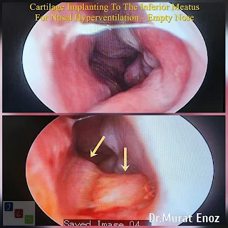 Cartilage Implanting To The Inferior Meatus For Nasal Hyperventilation - Empty Nose