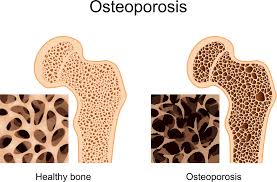 Obat Osteopororsis Lansia Blog