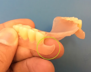 ventaja gancho protesis flexible dental