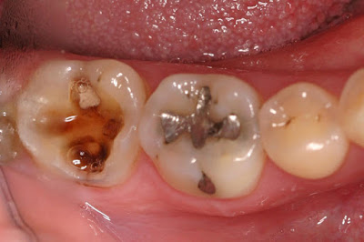 Penyebab Sakit Gigi Berlubang, Geraham, dan Gusi Berkepanjangan tidak Kunjung Sembuh