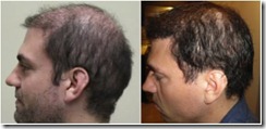 best-hair-transplant-clinic-in-the-world-1