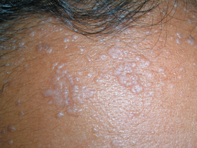 Symptoms of HPV