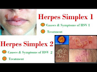 Tanaman Obat Untuk Menyembuhkan Herpes Secara Alami