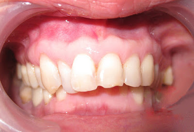 Có nên bọc răng sứ cho răng cửa bị hô? 