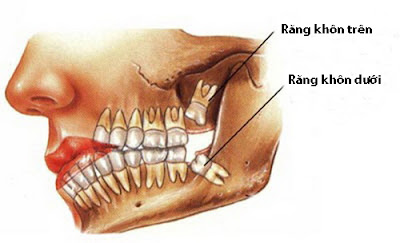 Răng khôn mọc sớm không gây ảnh hưởng sức khỏe 1