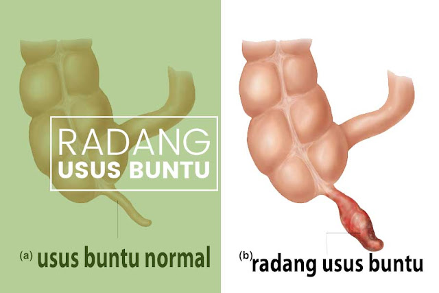 Gejala dan Penyebab Penyakit Usus Buntu