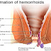 cara mengempeskan anus bengkak atau memar