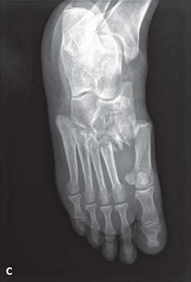 oblique radiographs Lisfranc Injury