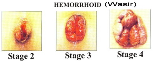 Pengobatan Wasir Pada Anak, Obat Ambeien Di Baganbatu, Jual Obat Wasir Di Pariaman, Obat Wasir Herbal Alami, Obat Wasir Di Makassar, Obat Wasir Berdarah, Obat Wasir Akut width=490