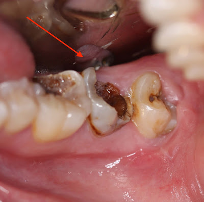 Có nên nhổ răng số 8 bị sâu không và cách nhổ an toàn