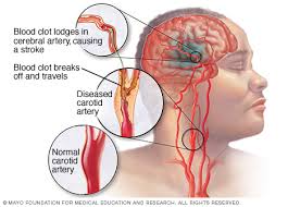 Bagaimana Cara Menyembuhkan Stroke Ringan?, apakah stroke bisa sembuh total?, Cara Obat Stroke Ringan Paling Mujarab