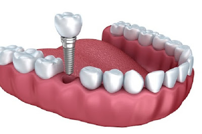 Làm răng implant mất bao lâu 