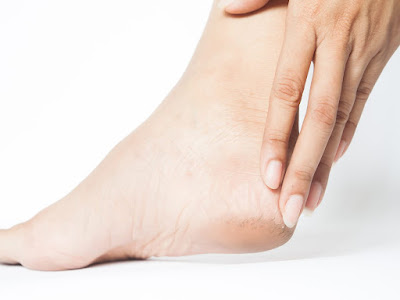 How to Fix Cracked Heels Permanently