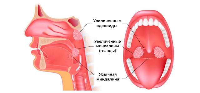 лечить ли аденоиды