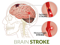 Tanya Pengobatan Stroke Ringan