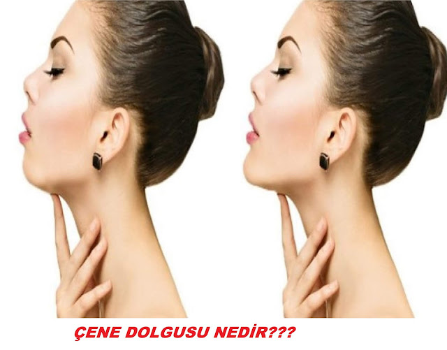 Çene Dolgusu nedir