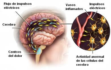 Dolor de cabeza del tipo migraña