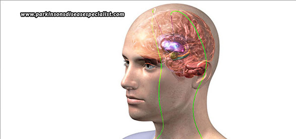 Deep Brain Stimulation for Parkinson's in UAE