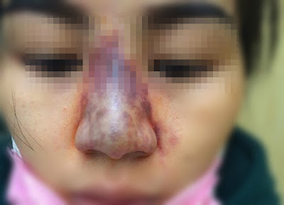 Hưng Yên: Cô gái 27 tuối suýt mất mũi vì tiêm filler vào đúng tĩnh mạch