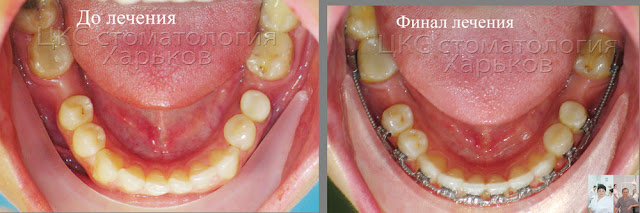 Зубы до лечения и в финале ношения брекетов