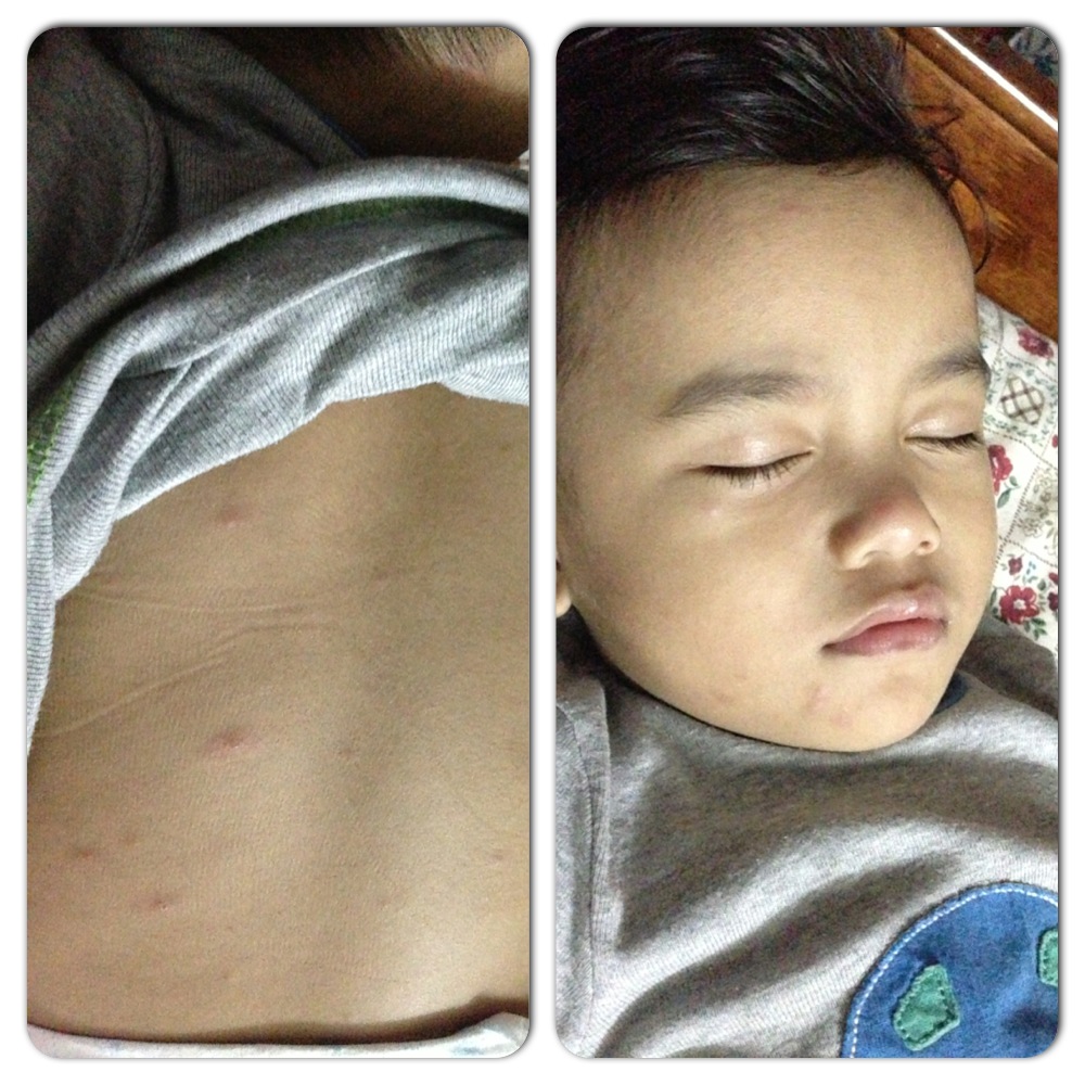 My story: Difference Between Measles and Chickenpox and RF