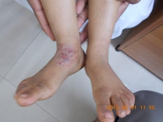 eczema image 1