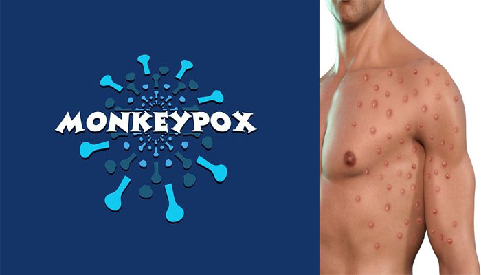 मंकीपॉक्स क्या है ? कैसे फैलता है और लक्षण क्या है ? | What is monkeypox virus, monkeypox symptoms hindi ?