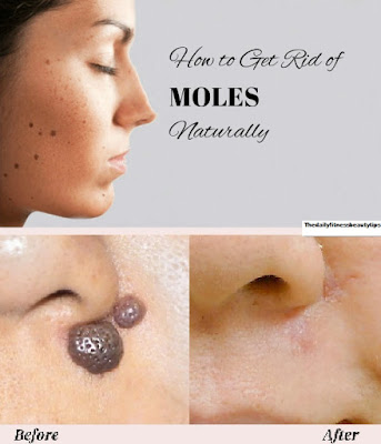 molr-removal-cream