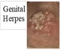 Genital Herpes