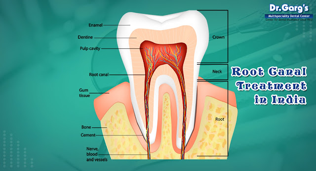 Root Canal Dentist