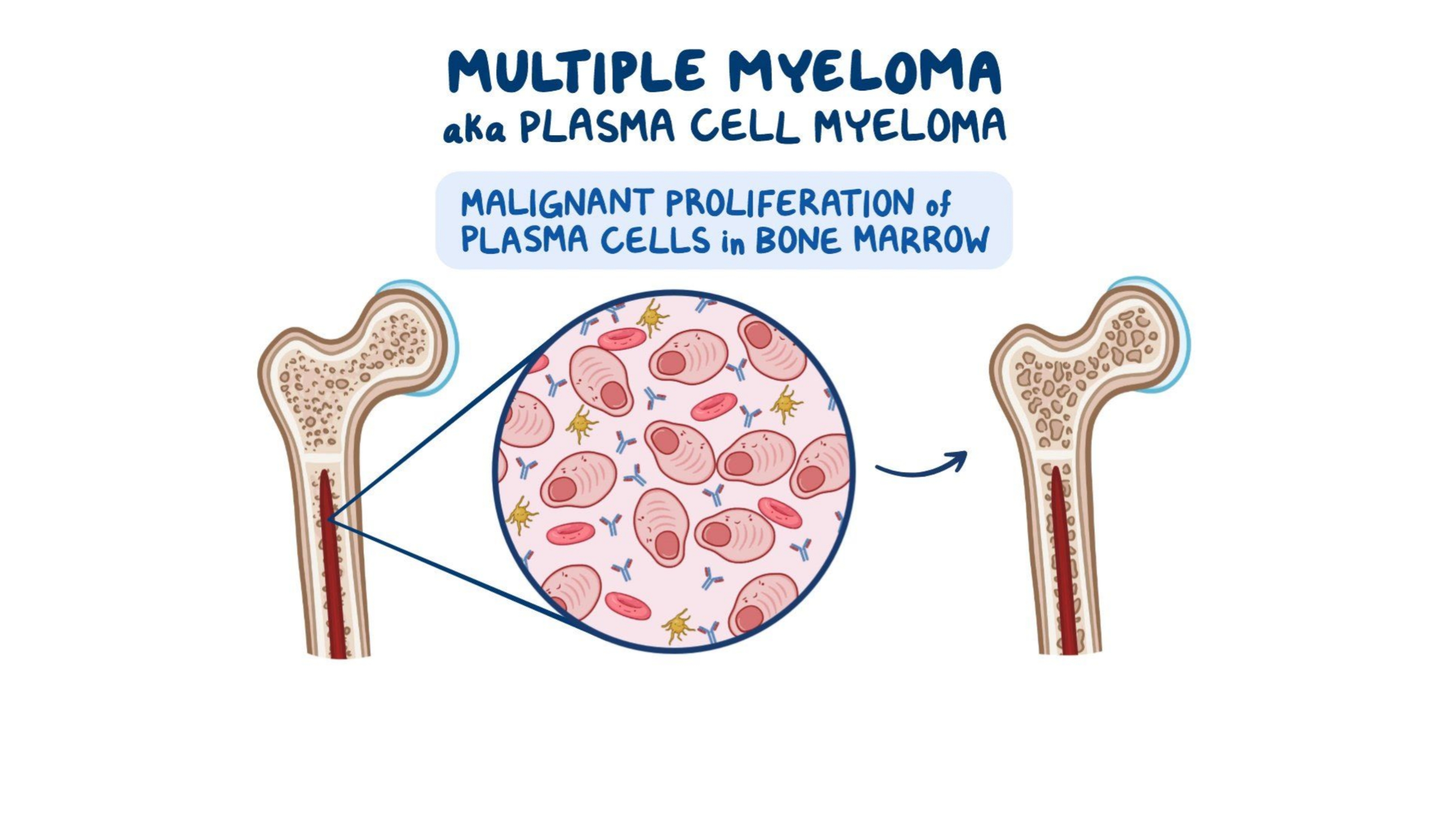 https://www.healthandfitnessexpert.in/2024/05/what-is-multiple-myeloma.html