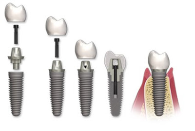 rang-su-implant