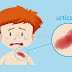 Pathophysiology of Urticaria