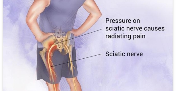 All you need to know about Nerve Pains -Sciatica