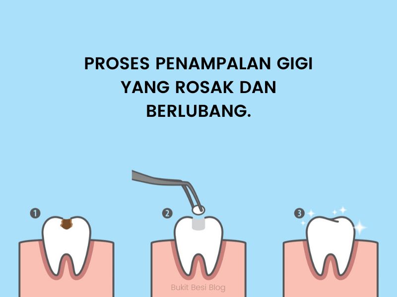 Punca Sakit Gigi Selepas Ditampal & Petua Hilangkan 