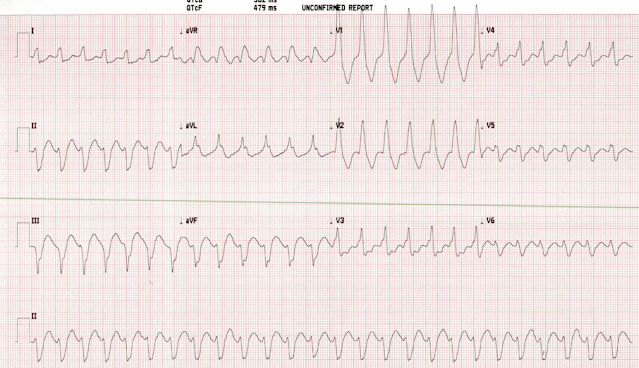 An asymptomatic man in his 50s with heart rate in the 160s - what is the diagnosis? How will you manage this?