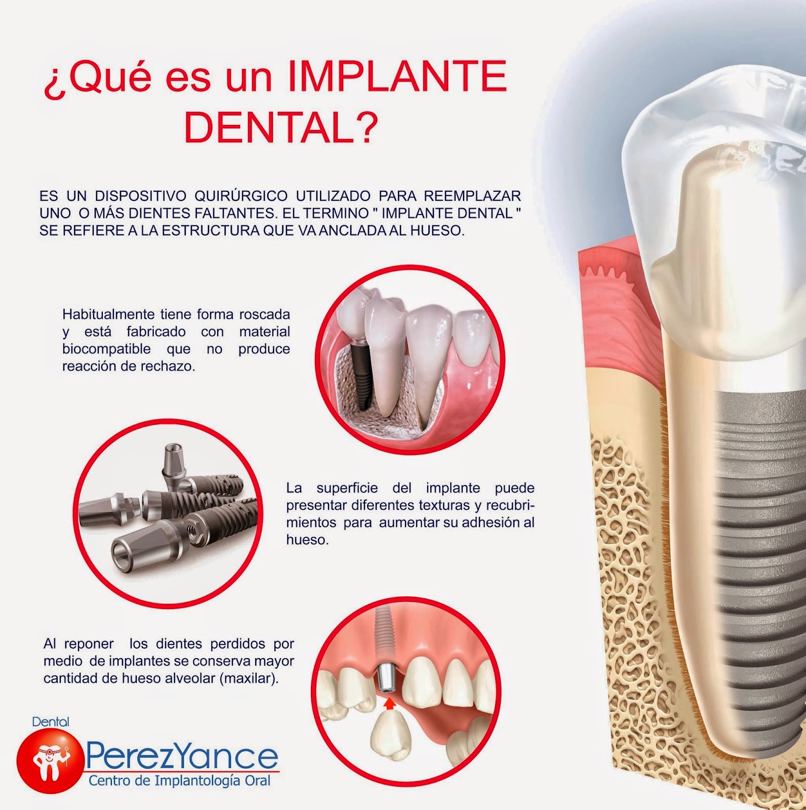  Implante Dental Peru