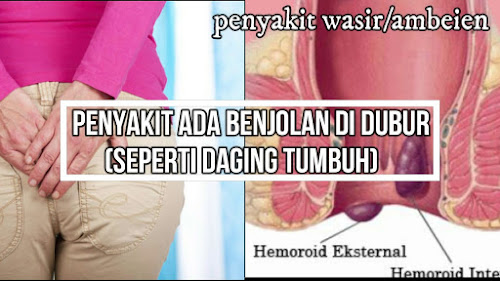 Jual Ambejoss Di Cempaka Putih, Jakpus (Obat Wasir Tanpa Operasi). WA 085741172714