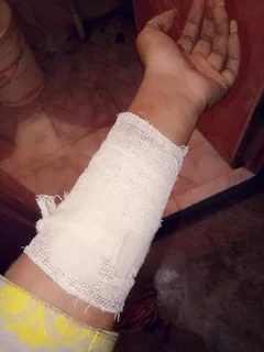 বেন্ডেজ লাগানো হাত কাটা ছবি