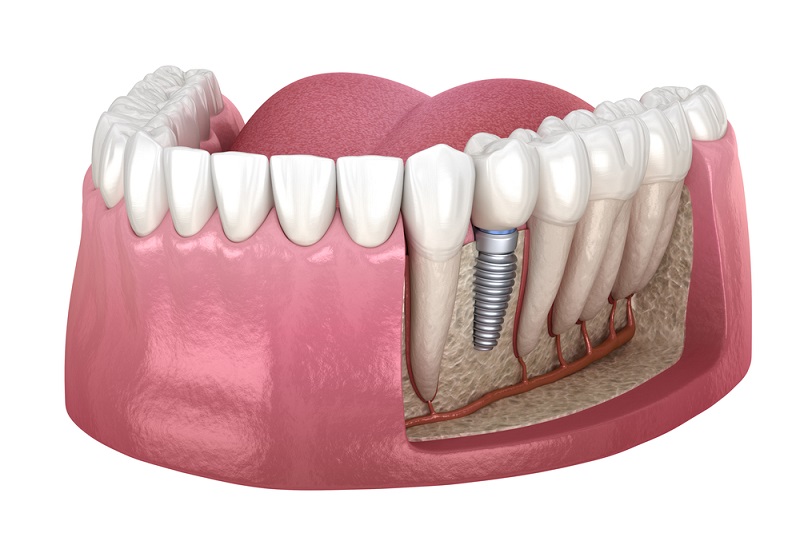 Denture Implants