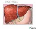 fatty liver