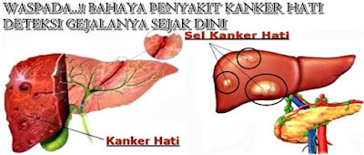 Obat Tumor Hati Alami, Ampuh Menyembuhkan Tumor Hati Secara Alami Tanpa Operasi