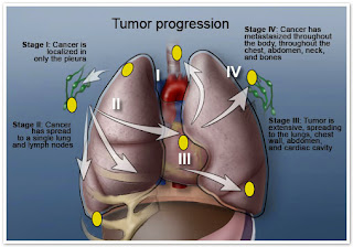 stages mesothelioma