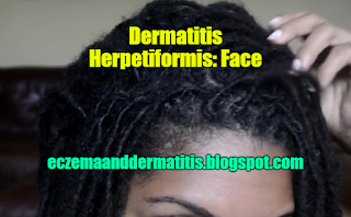 Dermatitis Herpetiformis: Face
