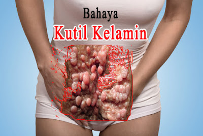 Obat Kutil Di Vagina