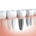 Cấy ghép implant giá bao nhiêu tiền ?