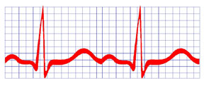 ECG