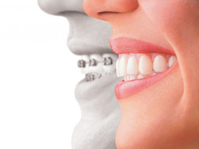 Phương pháp niềng răng có làm thay đổi khuôn mặt