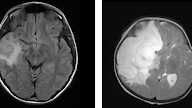 Abnormal mri brain “Peritumoral edema”